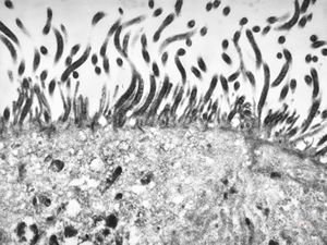 F,52y. | spirochetosis - colon F,52y. | spirochetosis - colon